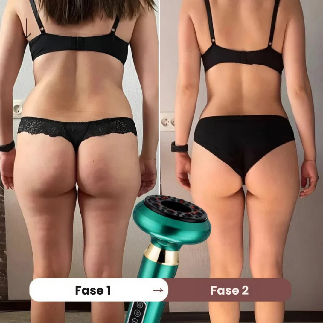 SmoothSculpt™ | Slätare hud, färre gropar – din hemliga lösning mot celluliter