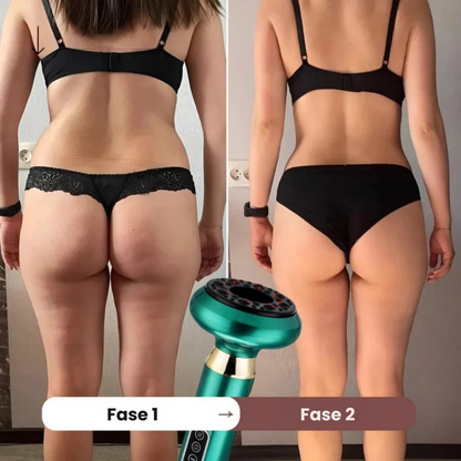 SmoothSculpt™ | Slätare hud, färre gropar – din hemliga lösning mot celluliter