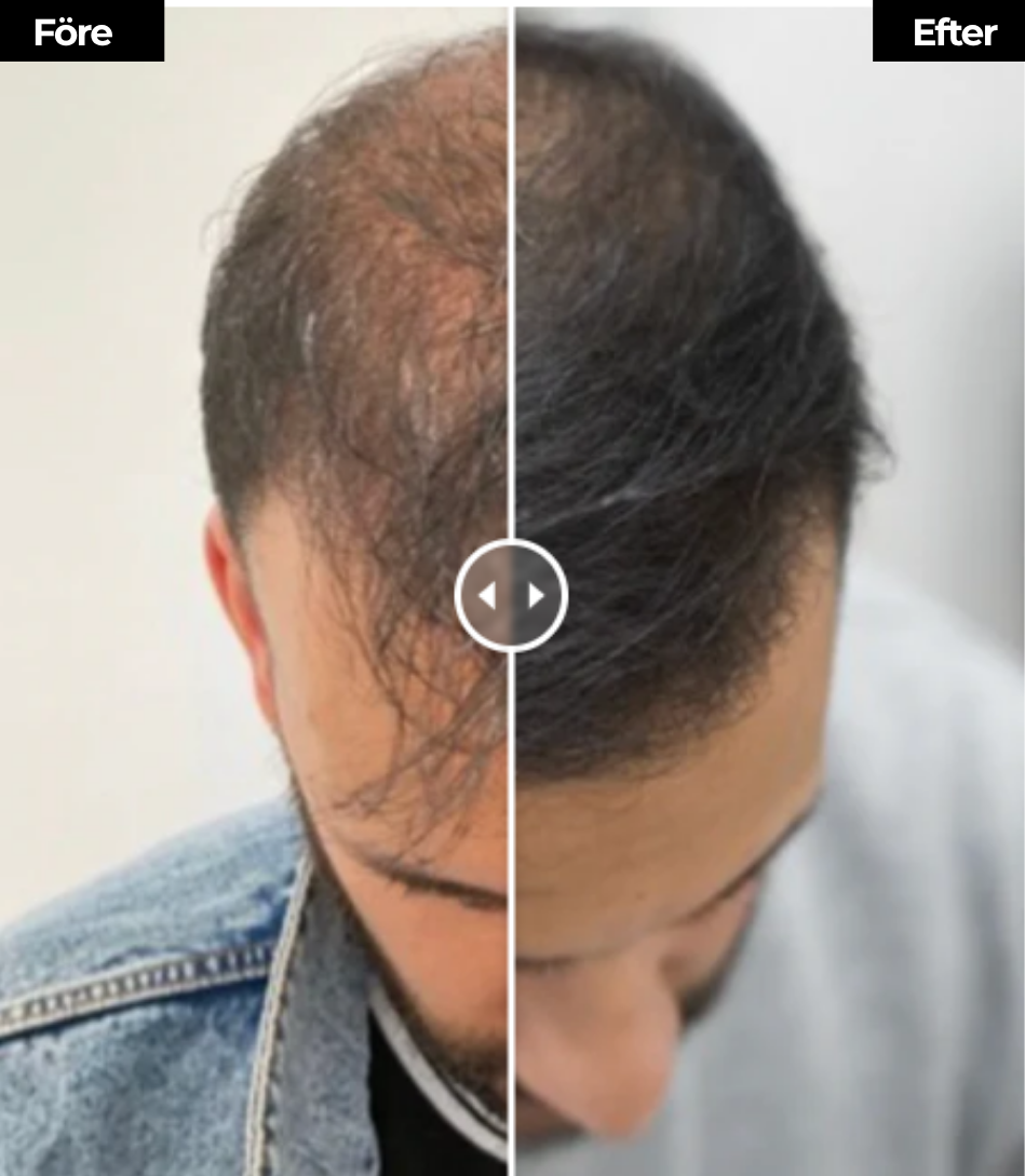 LumiStrand™ | Återfå fylligt, livfullt hår – helt naturligt och utan bekymmer